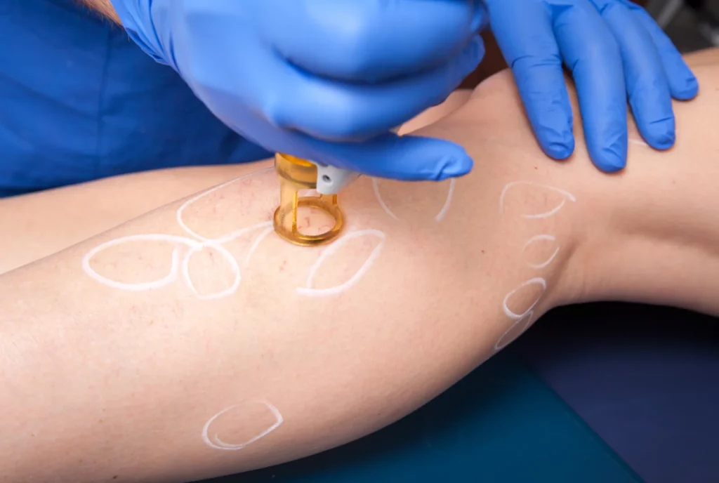 how quickly do spider and varicose veins heal after laser treatment