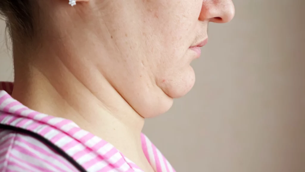 what causes a double chin